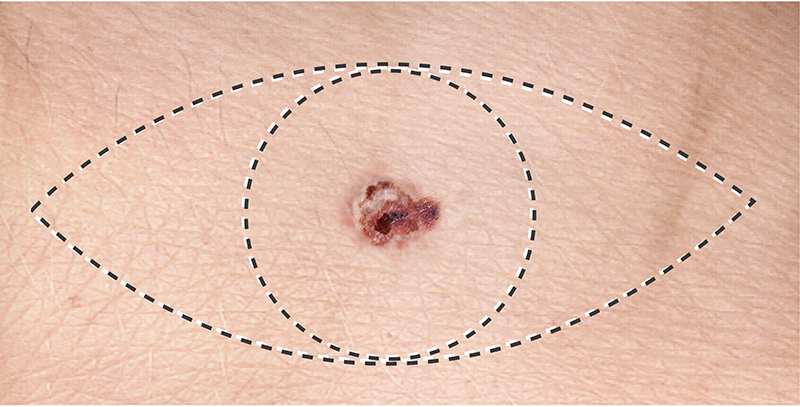 Surgical incision to remove melanoma, a highly malignant skin cancer that arises in melanocytes. 