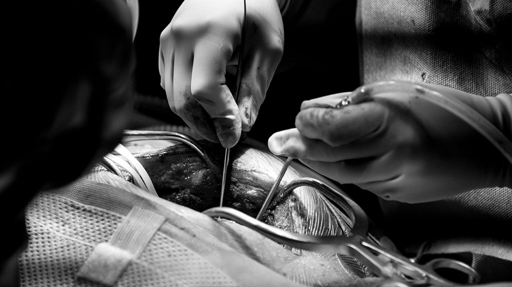 dual-spinal-surgery-wound-opening