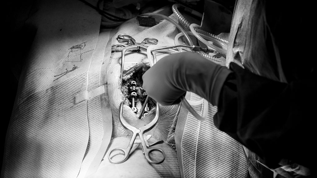 dual-spinal-surgery-wound-opening-with-cag