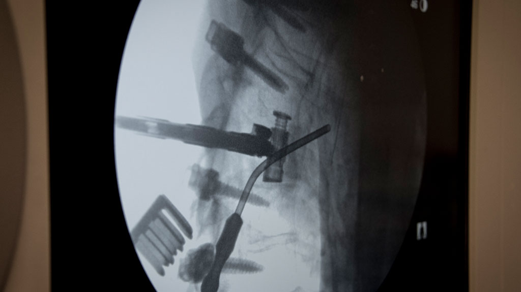 dual-spinal-surgery-xray