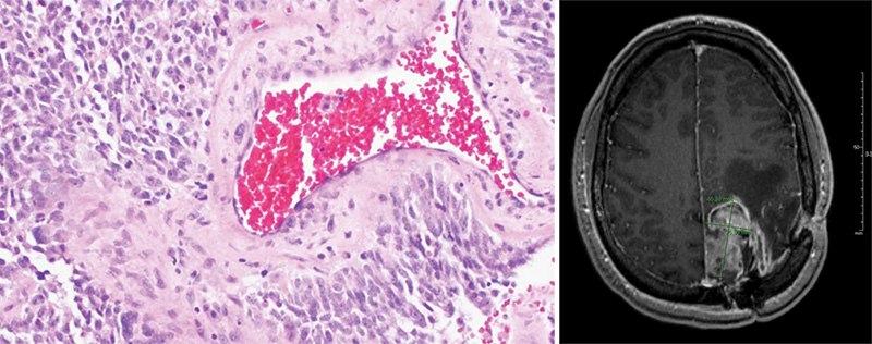 hopseq-glioma