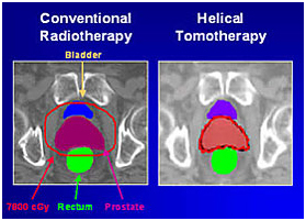 conventional-vs-helical