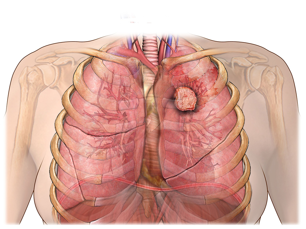 Illustration of a female thorax with lungs and a large tumor mass in the left lung.
