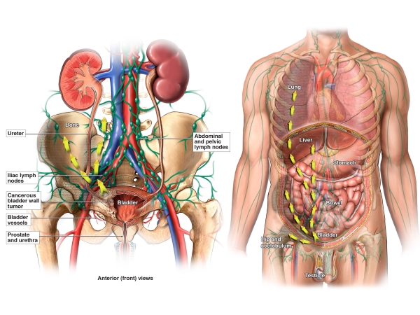 The metastasis of high-grade muscle-invasive bladder cancer in the circulatory and lymphatic systems