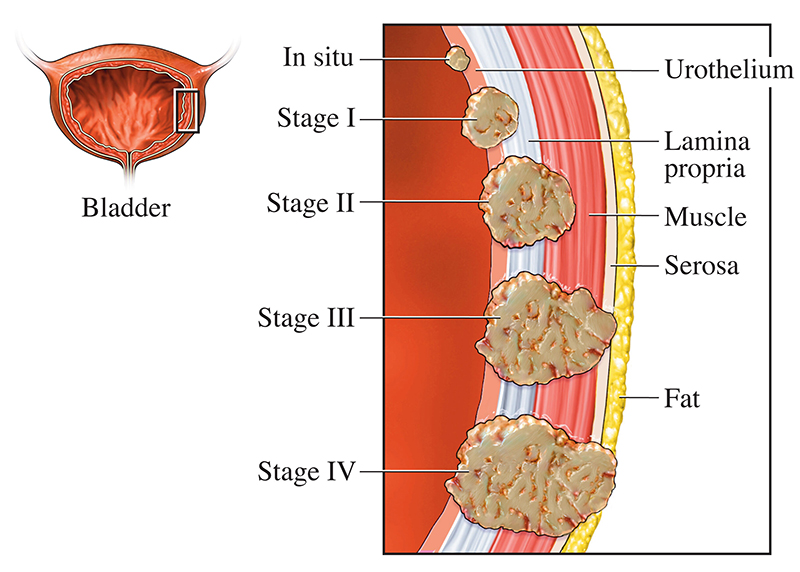 A medical illustration of the four stages of bladder cancer.