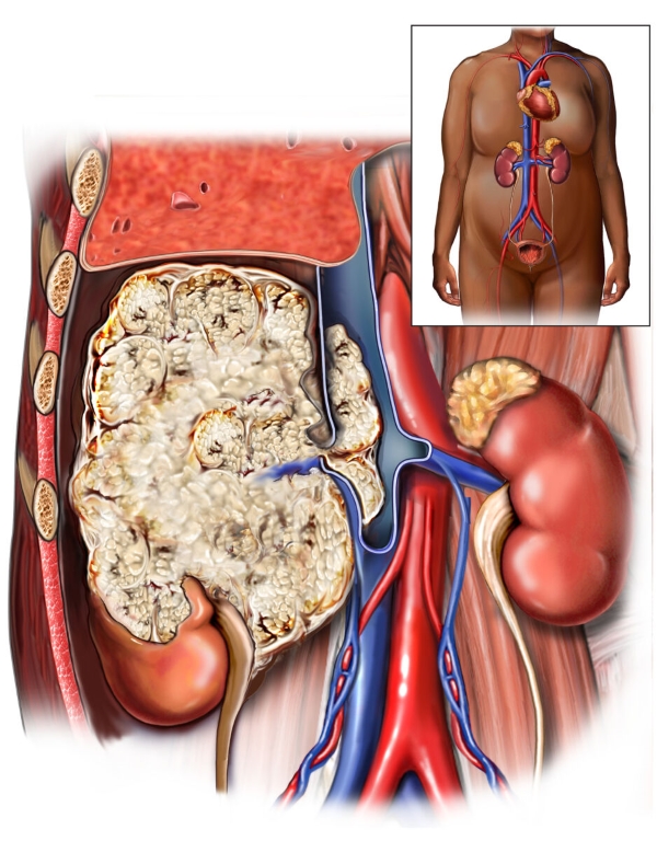 Cancer extends beyond kidney towards the liver and invades inferior vena cava medial to this mass