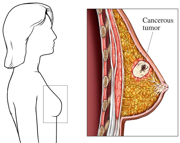A cancerous tumor within the breast tissue.