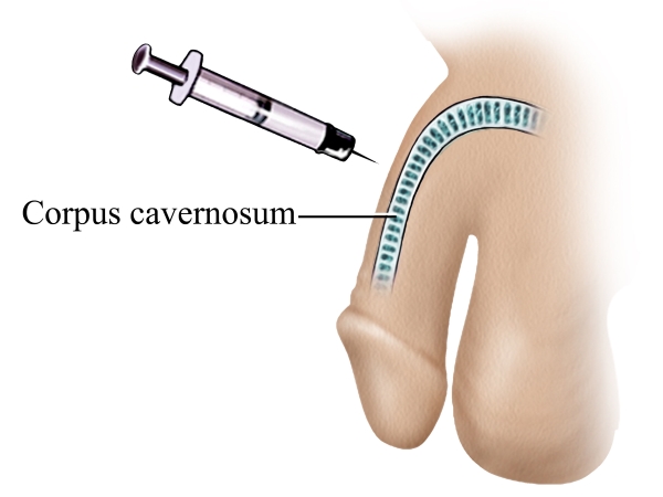Medical injection to the corpus cavernosum of the penis to treat impotence