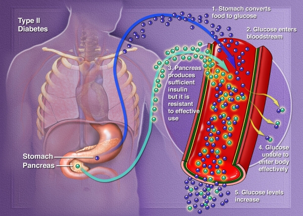Medical illustration demonstrating type 2 diabetes.