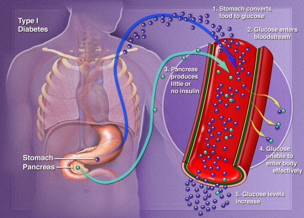 Medical illustration demonstrating type 1 diabetes.