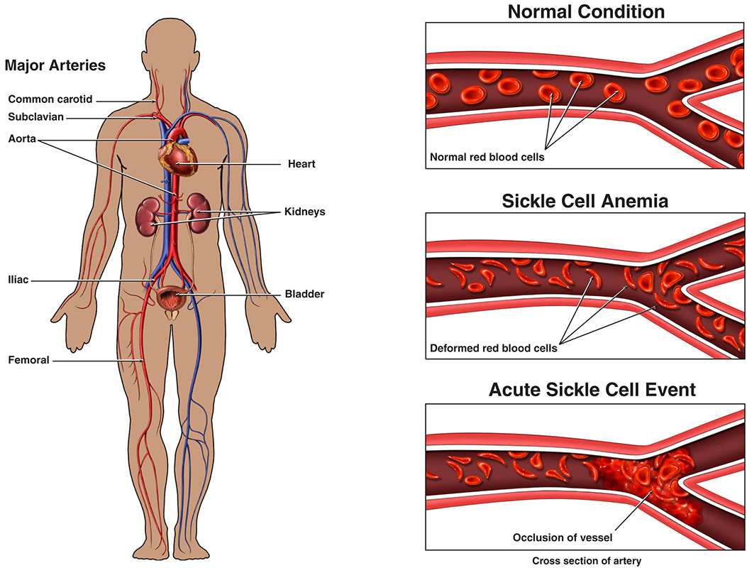 An illustration showing how sickle cells can cause a blocked artery.