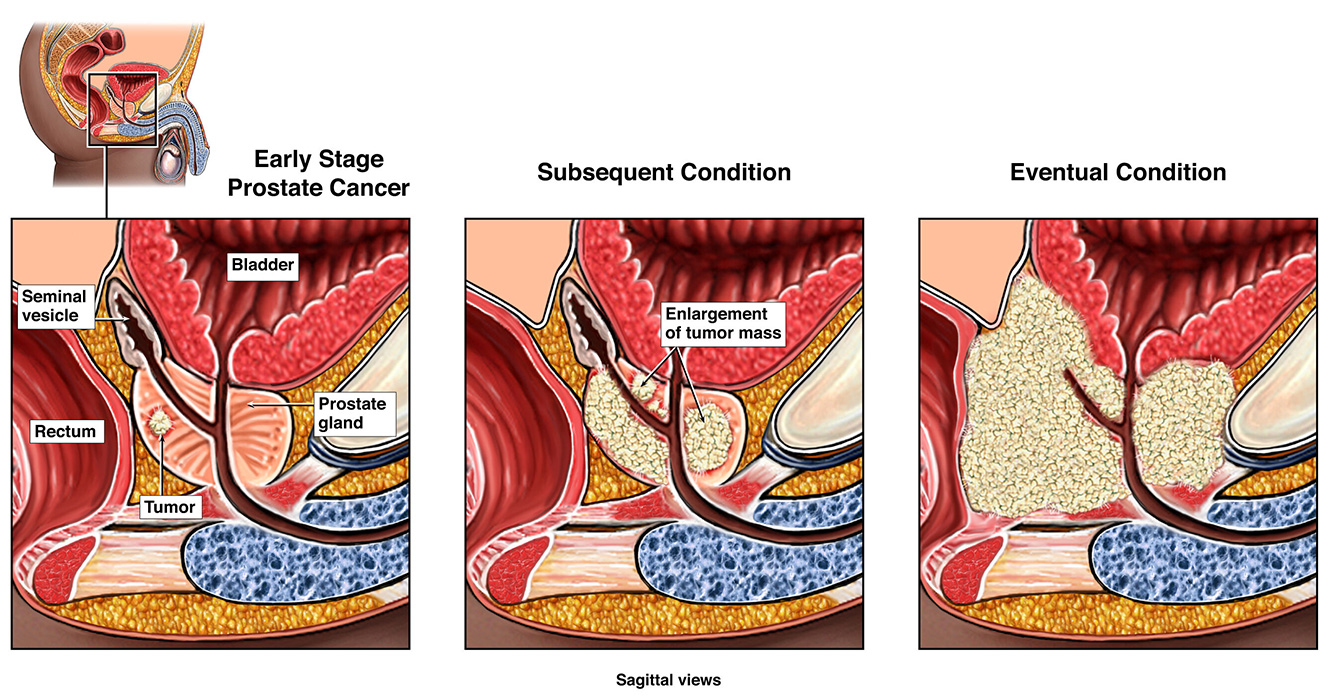 An exhibit showing the development of prostate cancer in three stages.