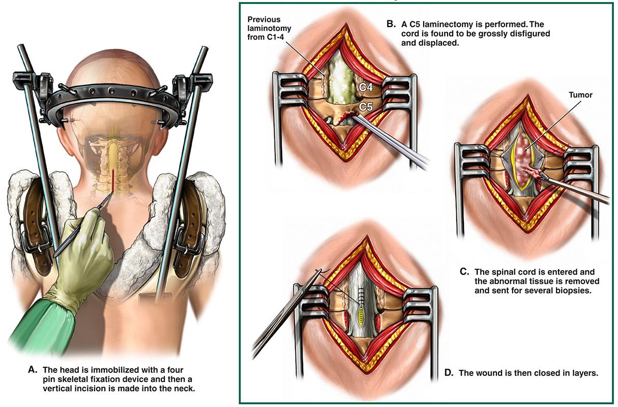 Medical illustration of surgical resection of a tumor on the cervical spinal cord.