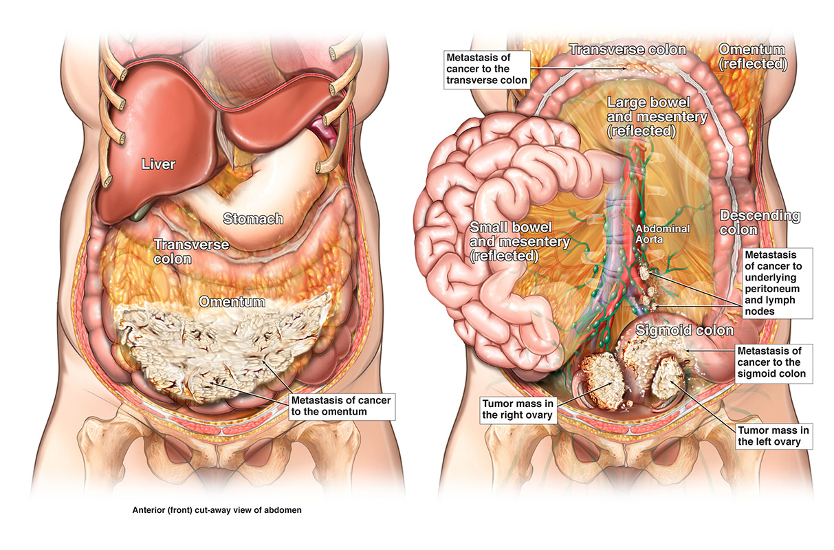 Side by side images of a female abdomen with metastasized ovarian carcinoma (cancer). 