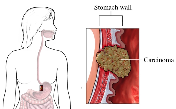 Medical illustration of a malignant carcinoma on the stomach wall.