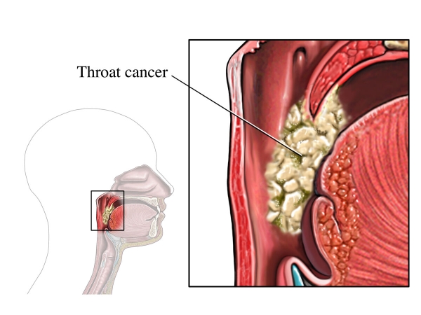 Outline of a head with the upper respiratory system demonstrates cancer in the throat.