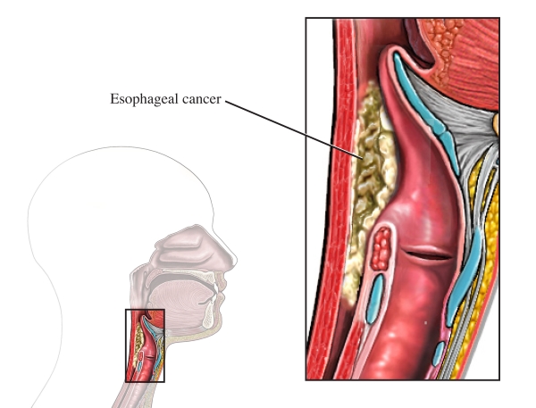 Medical illustration of an esophageal tumor.