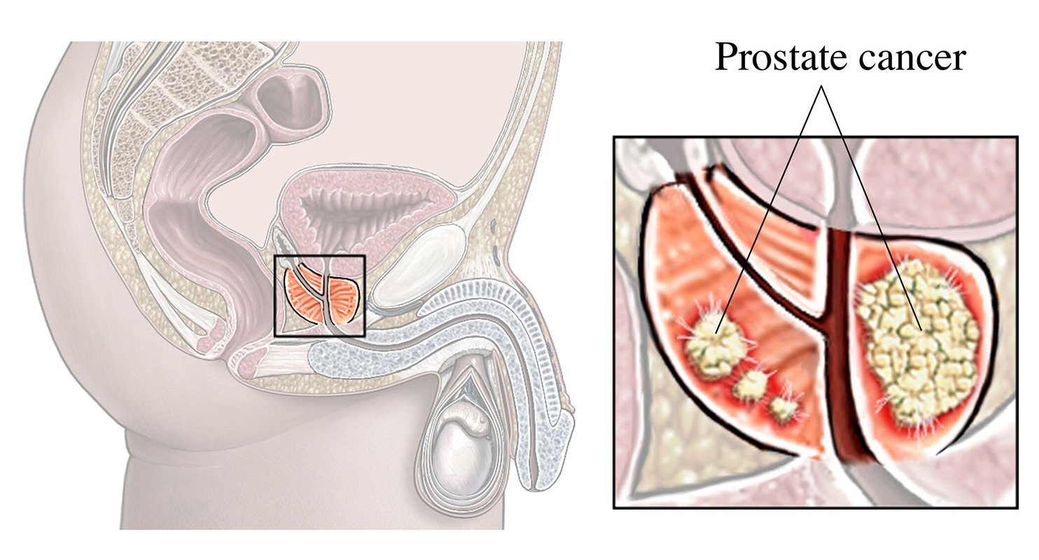 A cross-section of a malignant tumor inside a prostate gland.