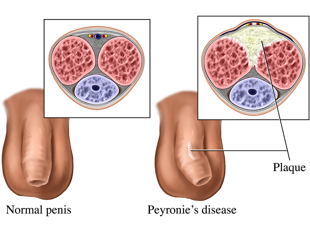 Compared to a normal, a penis with Peyronie's disease slightly bends mid-shaft due to plaque buildup