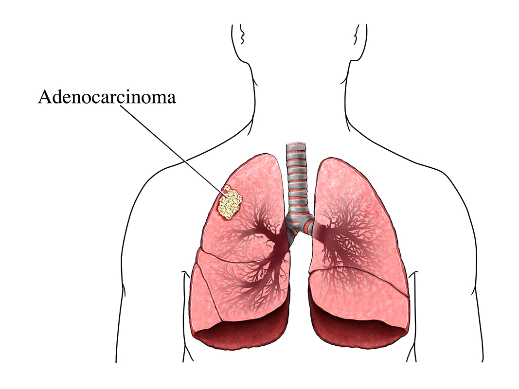 An outline silhouette of a male upper torso showing adenocarcinoma in the trachea and lungs area