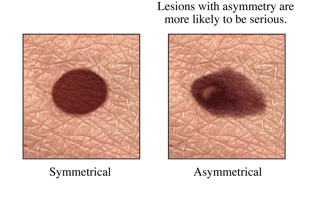 A mole with a regular border and a mole with an irregular border associated with skin cancer