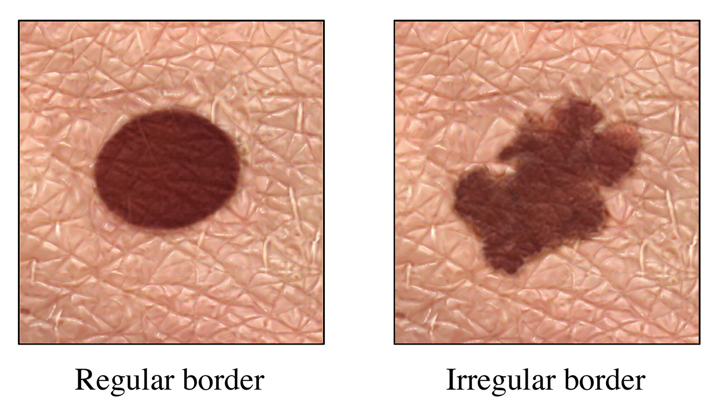 Compare a mole with a regular border and a mole with an irregular border associated with skin cancer