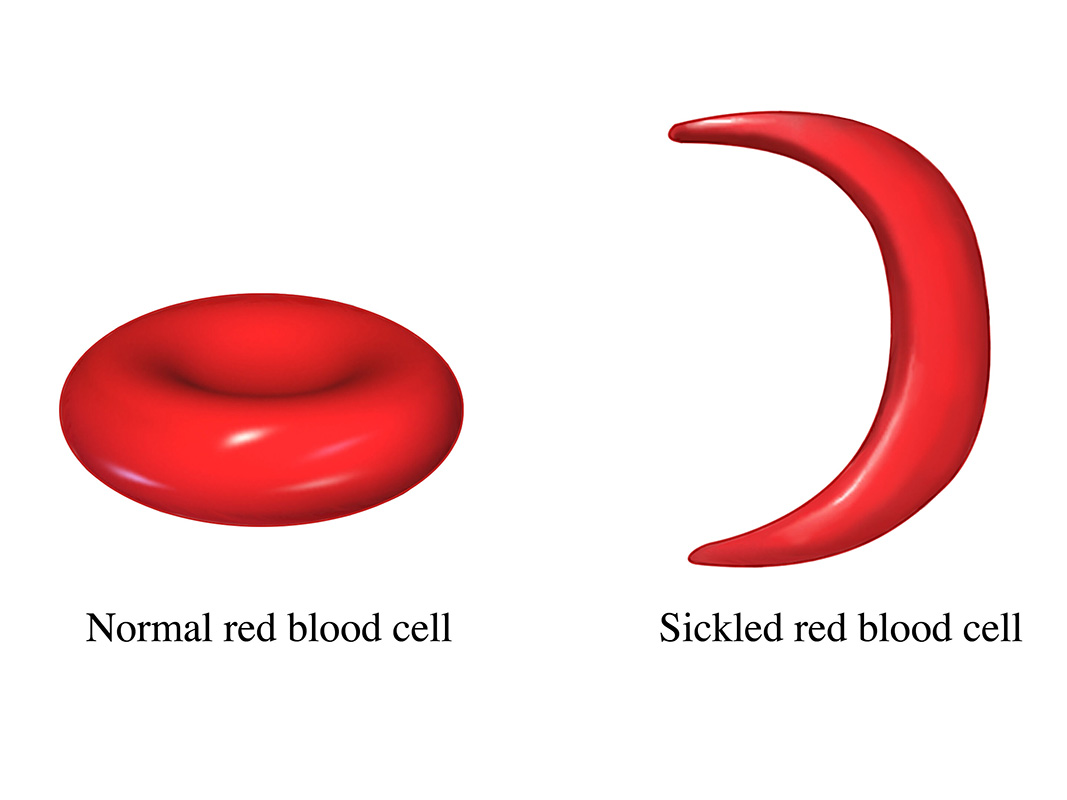 An image comparing a normal red blood cell and a sickled red blood cell.