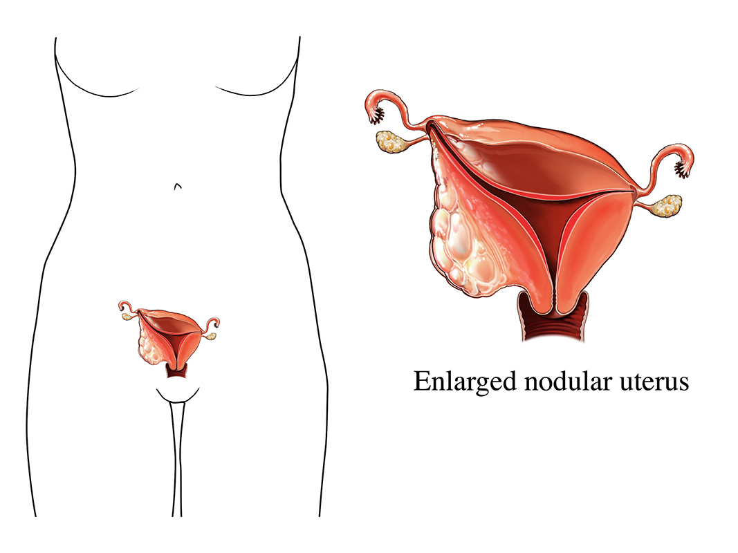 An illustration of an outline silhouette of a female abdomen and pelvis with the uterus visible, demonstrating an enlarged nodule on the uterine wall.