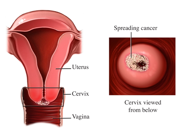 The cervix viewed from below shows spreading cancer on the cervix between the vagina and the uterus
