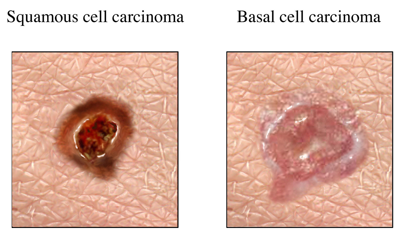 An image comparison of squamous cell carcinoma and basal cell carcinoma.