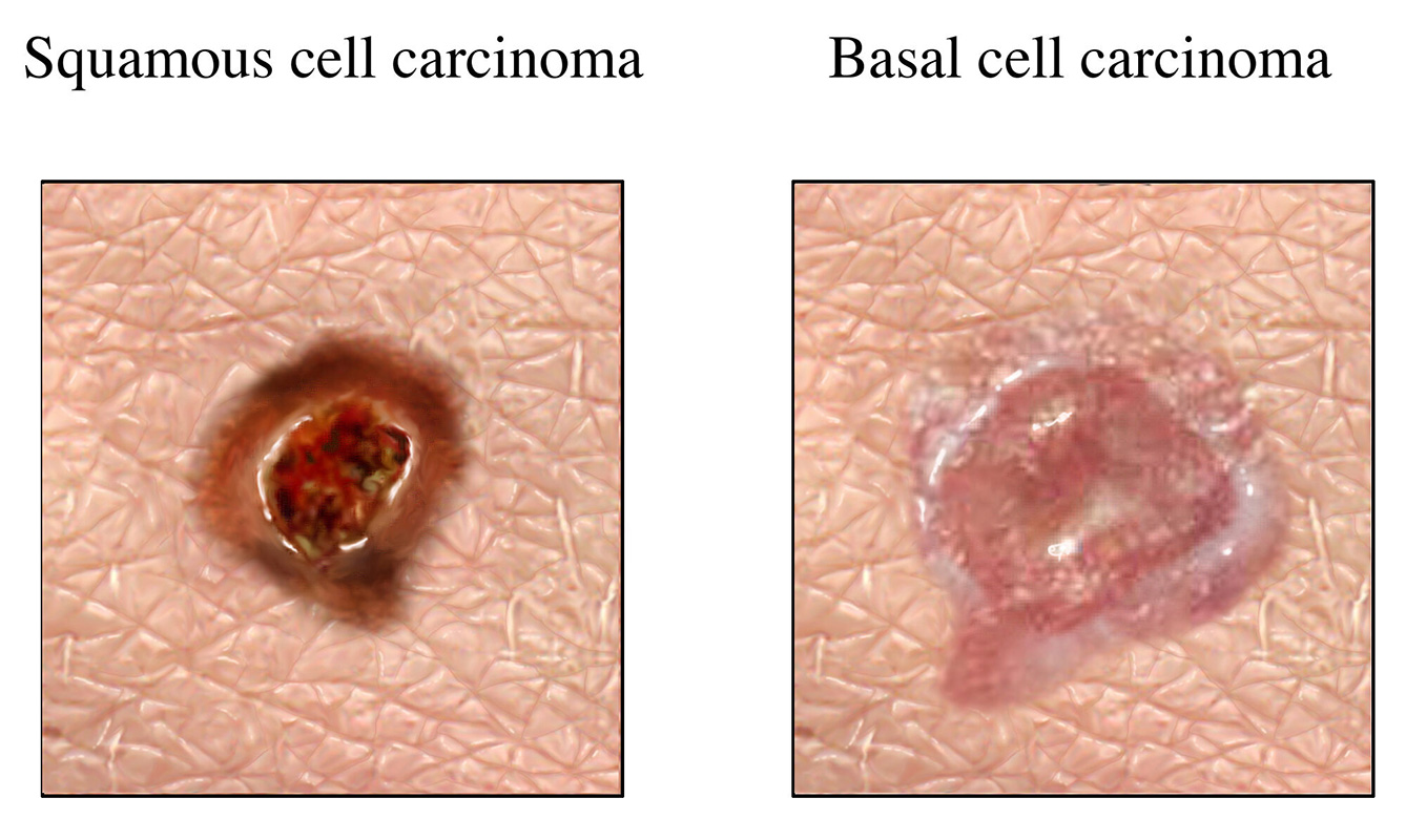 Comparison of squamous cell carcinoma and basal cell carcinoma.