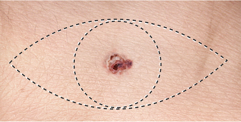 Illustration of surgical incision to remove or excise a melanoma, a highly malignant type of skin cancer that arises in melanocytes.