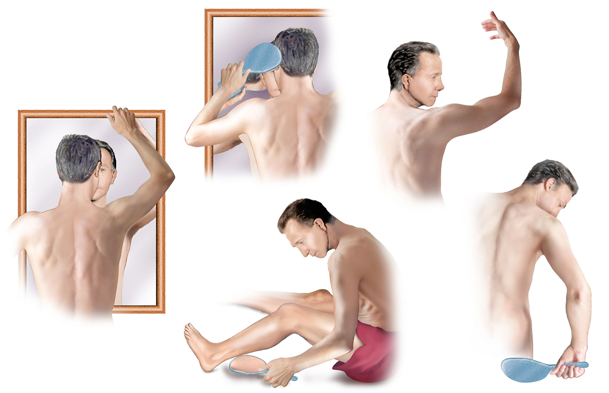Five illustrations of a male figure demonstrating self-examination techniques for signs of melanoma. 