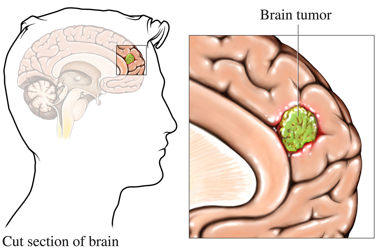 Small tumor located in the front of the brain.