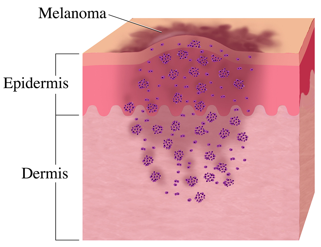 An exhibit of the anatomy of the skin with melanoma. A dark-pigmented melanoma lesion on the epidermis and the skin's dermis. 