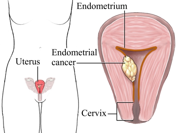Medical illustration of the anatomical placement of the uterus in the pelvis beside an image beside of a tumor in the endometrium.