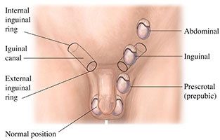 Diagram of undescended testicle