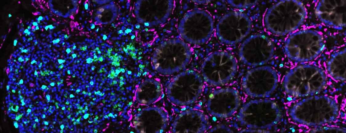 Gastrointestinal tumor microenvironments microscopic Purple Cells