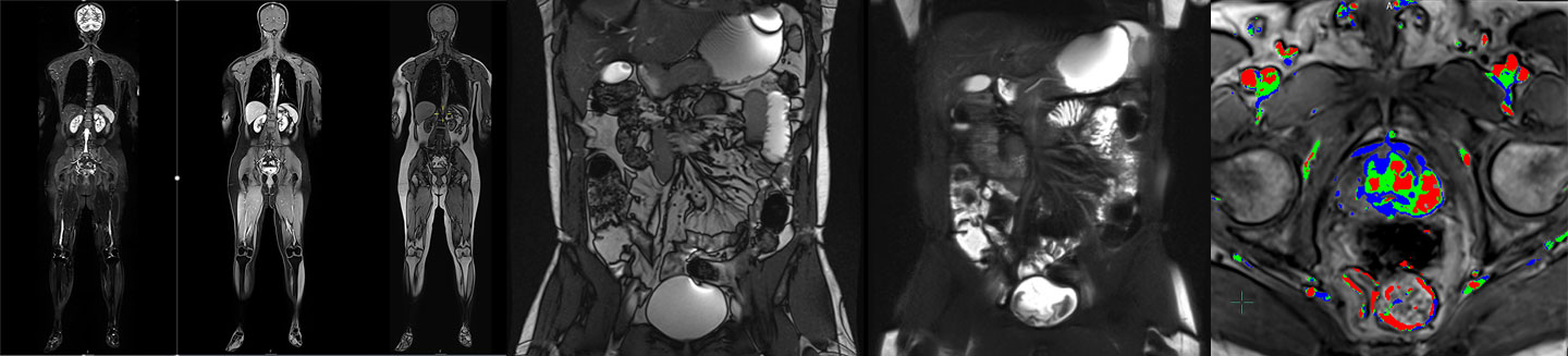MRI whole body, enterography and prostate