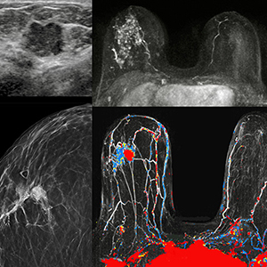 MRI and US image