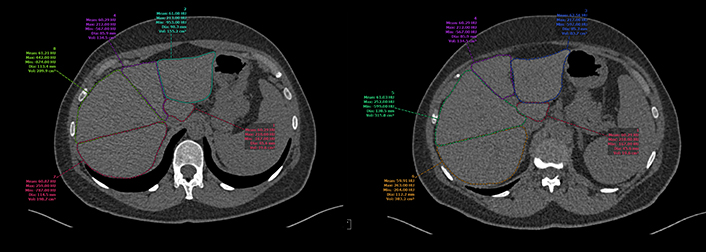 3D imaging: liver volumetrics and segmental volume