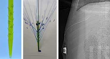 Intratumoral infusion port catheter
