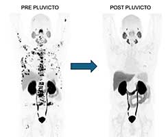 Pluvicto, a radioligand therapy for prostate-specific membrane antigen