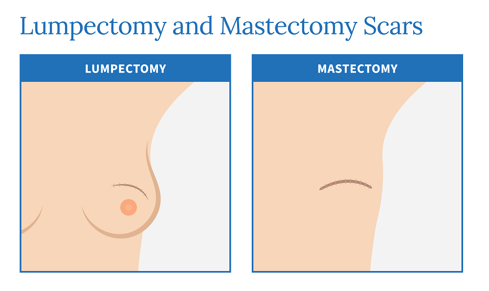 Lumpectomy: What Is It, Procedure & Recovery
