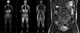 MRI whole body, enterography and prostate scans