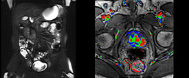 MRI whole body, enterography and prostate scans