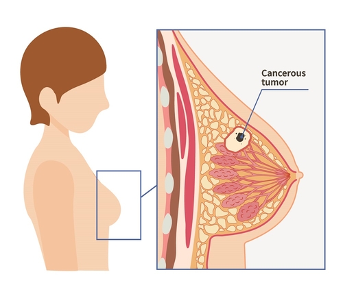 Breast cancer tumor