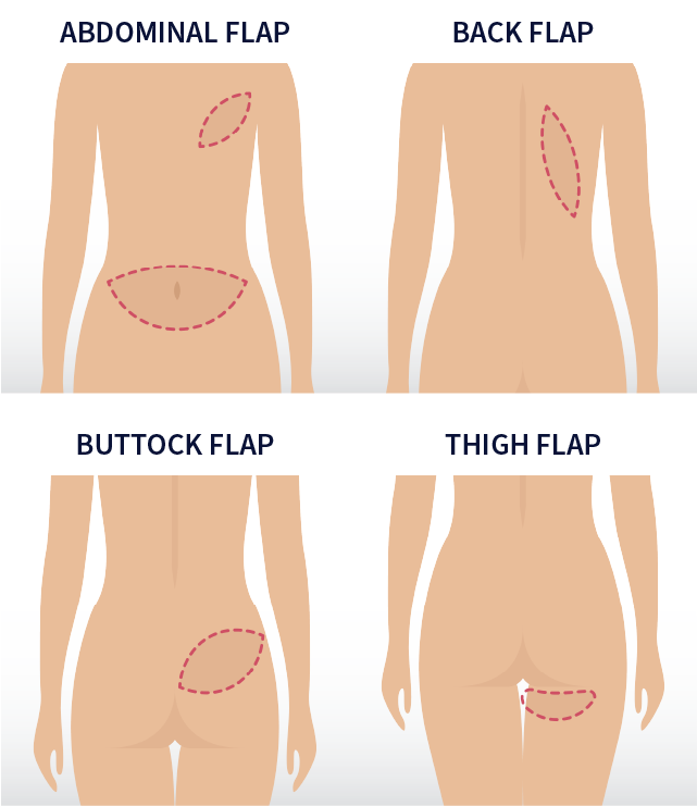 flap surgery breast cancer