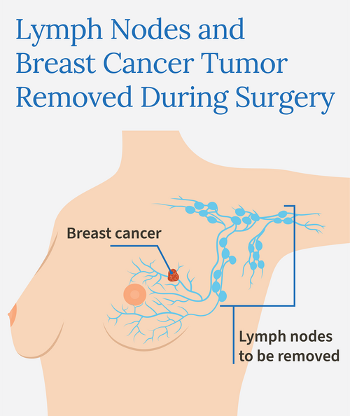 lymph nodes removed during breast cancer surgery