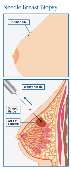 needle breast biopsy